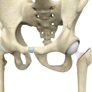 Picture of Hip Hemiarthroplasty