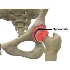 Picture of Hip Synovitis