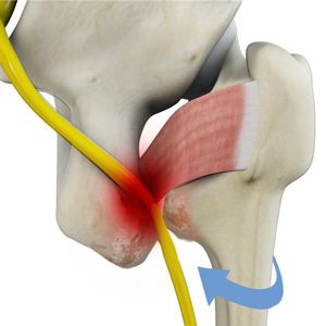 Picture of Ischiofemoral Impingement