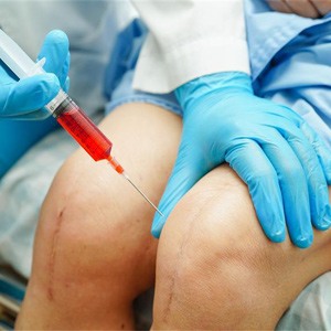 Picture of Knee Osteoarthritis Treatment