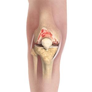 Picture of Knee Osteoarthritis
