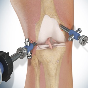 Picture of Knee Surgery