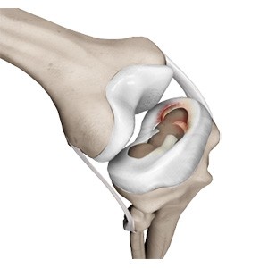 Picture of Meniscal Injuries