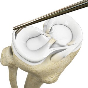 Picture of Meniscectomy