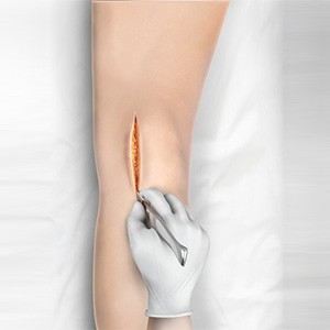 Picture of Minimally Invasive Knee Joint Replacement