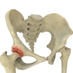 Picture of Osteoarthritis of the Hip