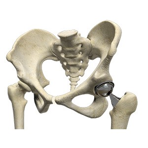 Picture of Outpatient Hip Replacement