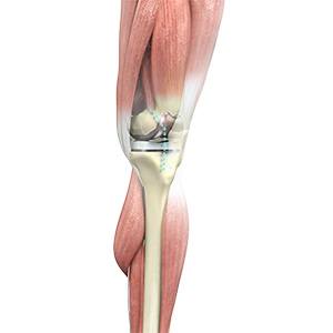 Picture of Outpatient Total Knee Replacement