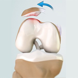Picture of Patellofemoral Instability