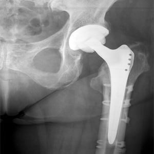 Picture of Periprosthetic Hip Fracture Management