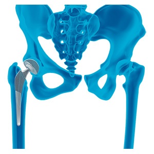 Picture of Primary Hip Replacement