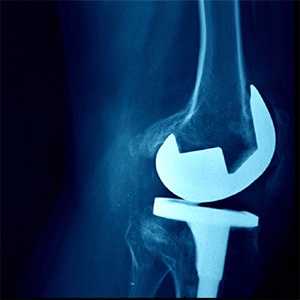 Picture of Primary Knee Replacement