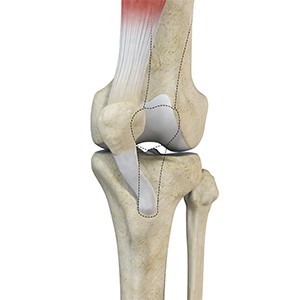 Picture of Recurrent Patella Dislocation