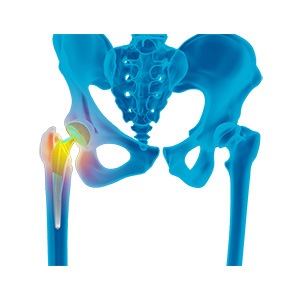 Picture of Revision Hip Replacement