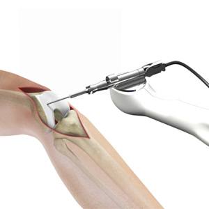 Picture of Robotic Assisted Knee Replacement