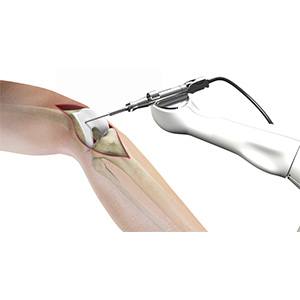 Picture of Robotic Assisted Partial Knee Surgery