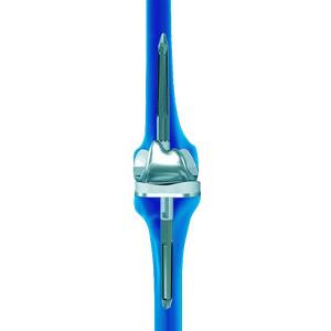 Picture of Robotic-Assisted Revision Knee Replacement