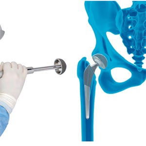 Picture of Robotic Total Hip Replacement