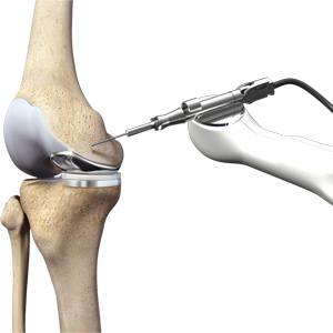 Picture of Robotic Unicondylar Knee Replacement
