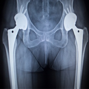 Picture of Same Day Hip Replacement