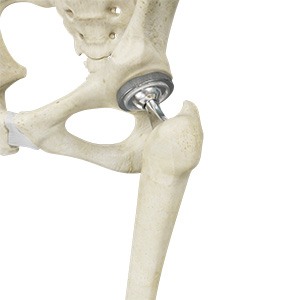 Picture of Total Hip Replacement