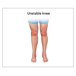 Picture of Unstable Knee