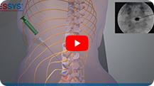 Spine Surgery Video