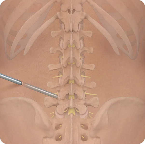 Endoscopic Spine Surgery