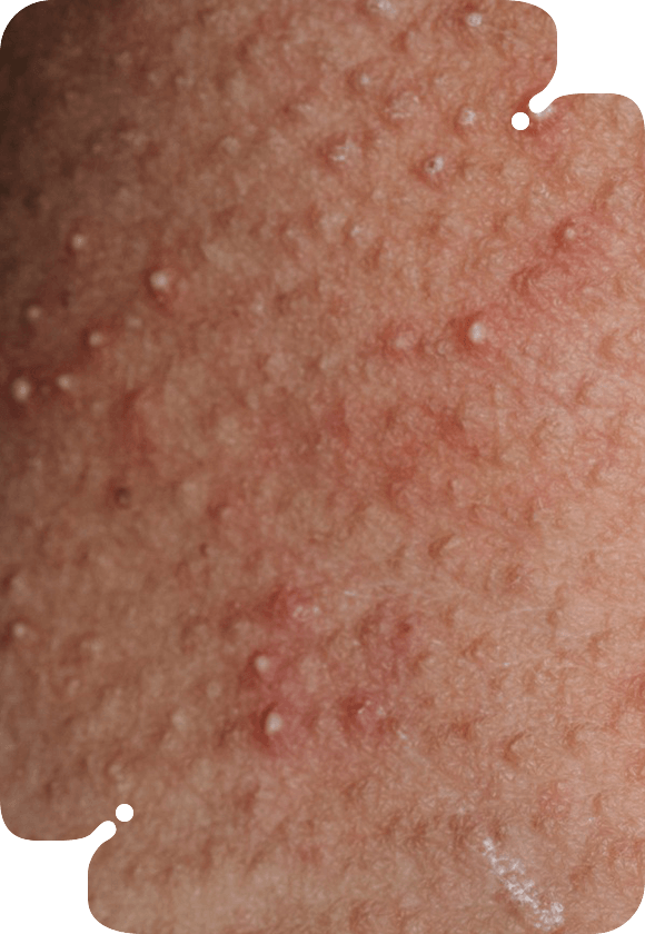 Close-up of skin with small bumps from milia extractions.