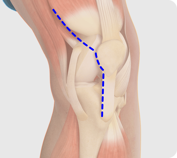 Jiffy Knee minimally invasive knee replacement procedure illustration