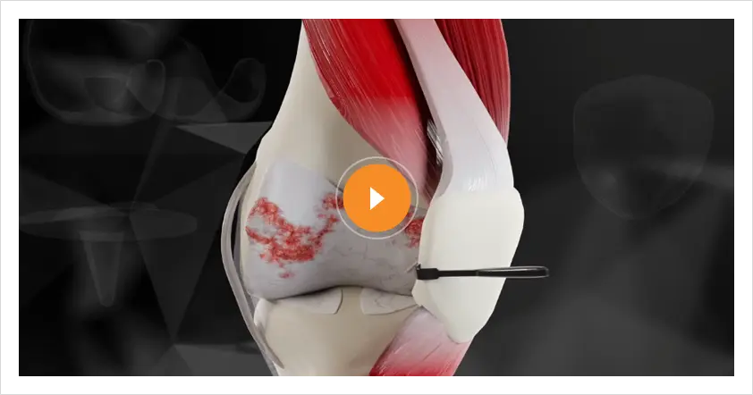 Jiffy Knee Img