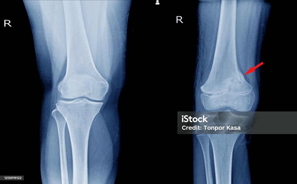 Picture of X-ray Knee AP views Showing Normal knee joint and fracture distal femur