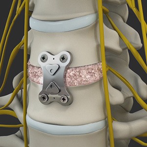 Anterior Cervical Discectomy With Fusion Picture