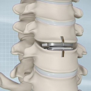 Cervical Disc Replacement Picture
