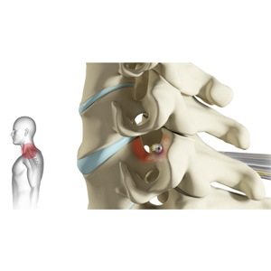 Cervical Foraminotomy Picture