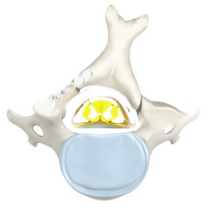Cervical Laminoplasty Picture