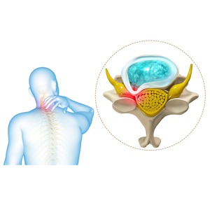 Cervical Myelopathy Picture