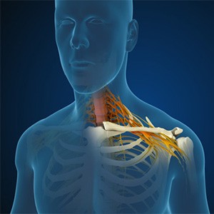 Cervical Radiculopathy Picture