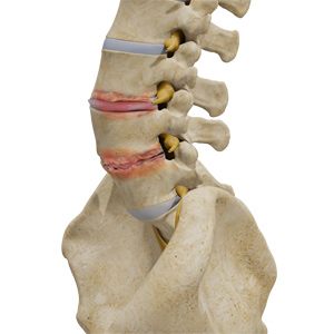 Degenerative Disc Disease Picture