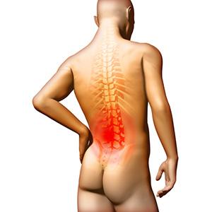 Flatback Syndrome Picture