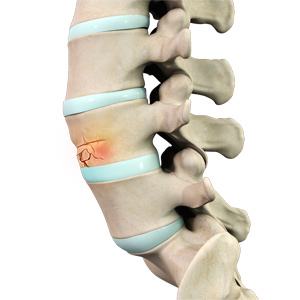 Fractures of The Spine Picture