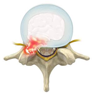Herniated Disc Picture