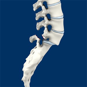 Isthmic Spondylolisthesis Picture