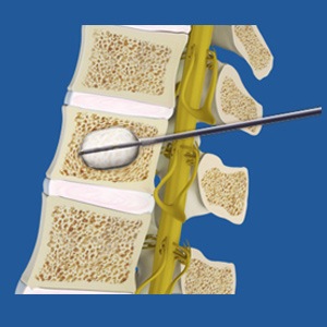 Kyphoplasty Picture