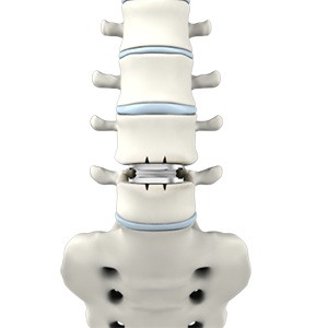 Lumbar Disc Replacement Picture