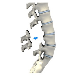 Lumbar Laminectomy Picture