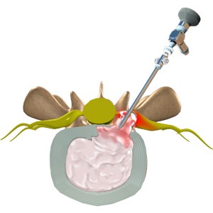 Lumbar Microdiscectomy Picture