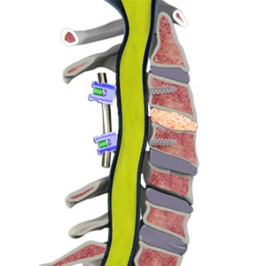 Nonunion Pseudarthrosis Picture