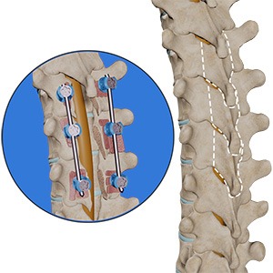 Post Laminectomy Syndrome / Failed Back Surgery Syndrome Picture