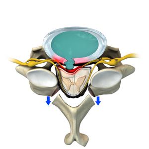 Posterior Cervical Laminectomy and Fusion Picture